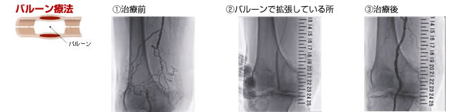 バルーン療法