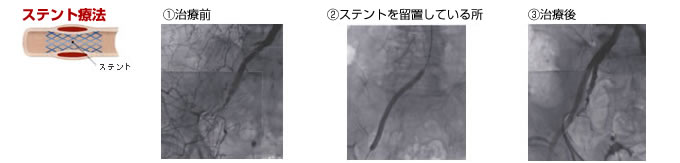 ステント療法